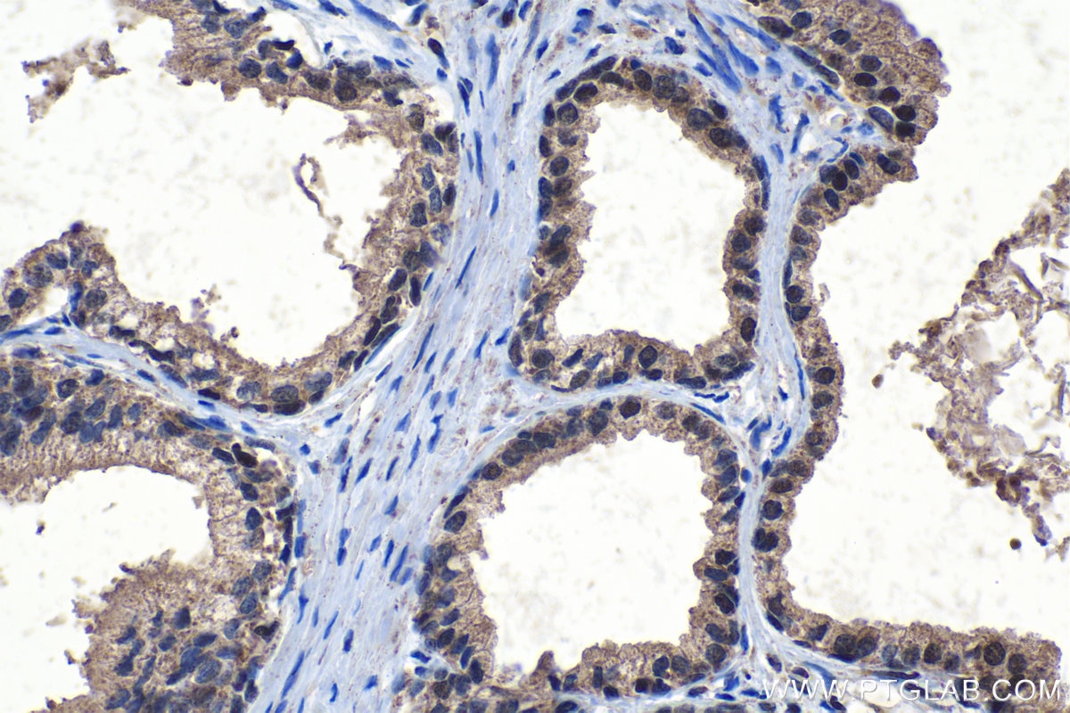 Immunohistochemical analysis of paraffin-embedded human prostate cancer tissue slide using KHC1107 (ELAC2 IHC Kit).