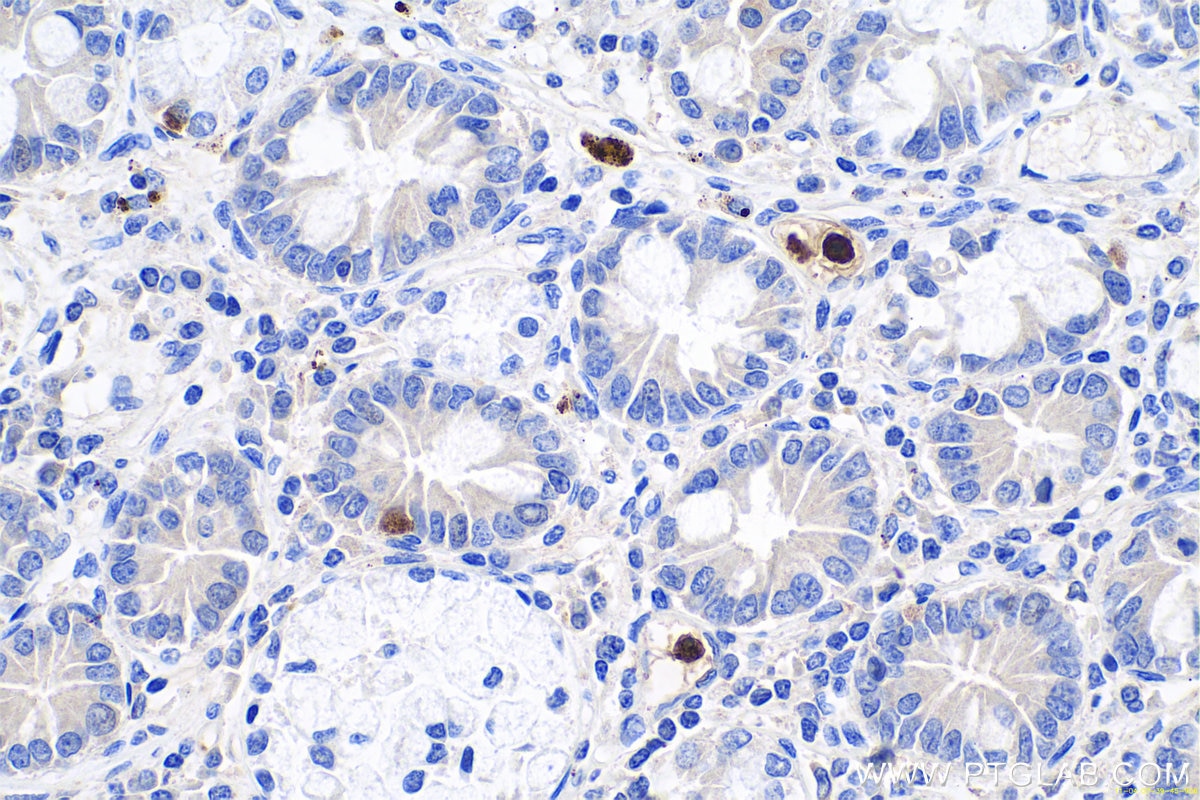 Immunohistochemical analysis of paraffin-embedded human stomach cancer tissue slide using KHC0695 (ELANE/ELA2 IHC Kit).