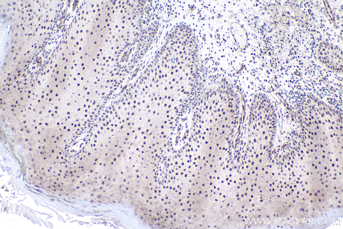 Immunohistochemical analysis of paraffin-embedded human skin cancer tissue slide using KHC1728 (ELOA IHC Kit).