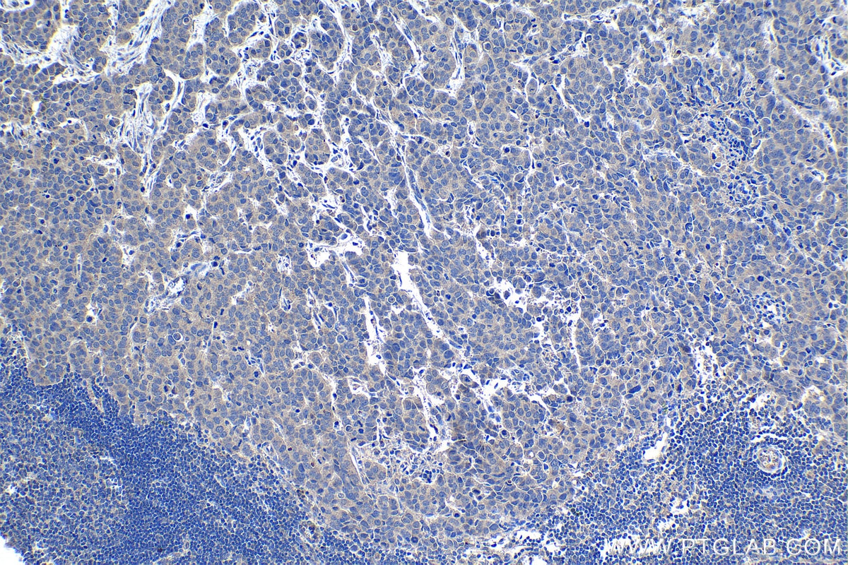 Immunohistochemical analysis of paraffin-embedded human breast cancer tissue slide using KHC1345 (ELOVL2 IHC Kit).