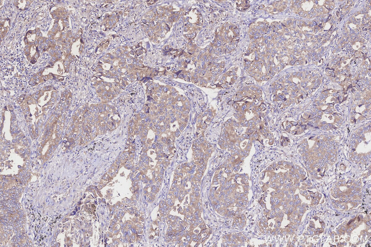 Immunohistochemical analysis of paraffin-embedded human lung cancer tissue slide using KHC3254 (EMC2/TTC35 IHC Kit). Immunohistochemical analysis of paraffin-embedded human lung cancer tissue slide using KHC3254 (EMC2/TTC35 IHC Kit).