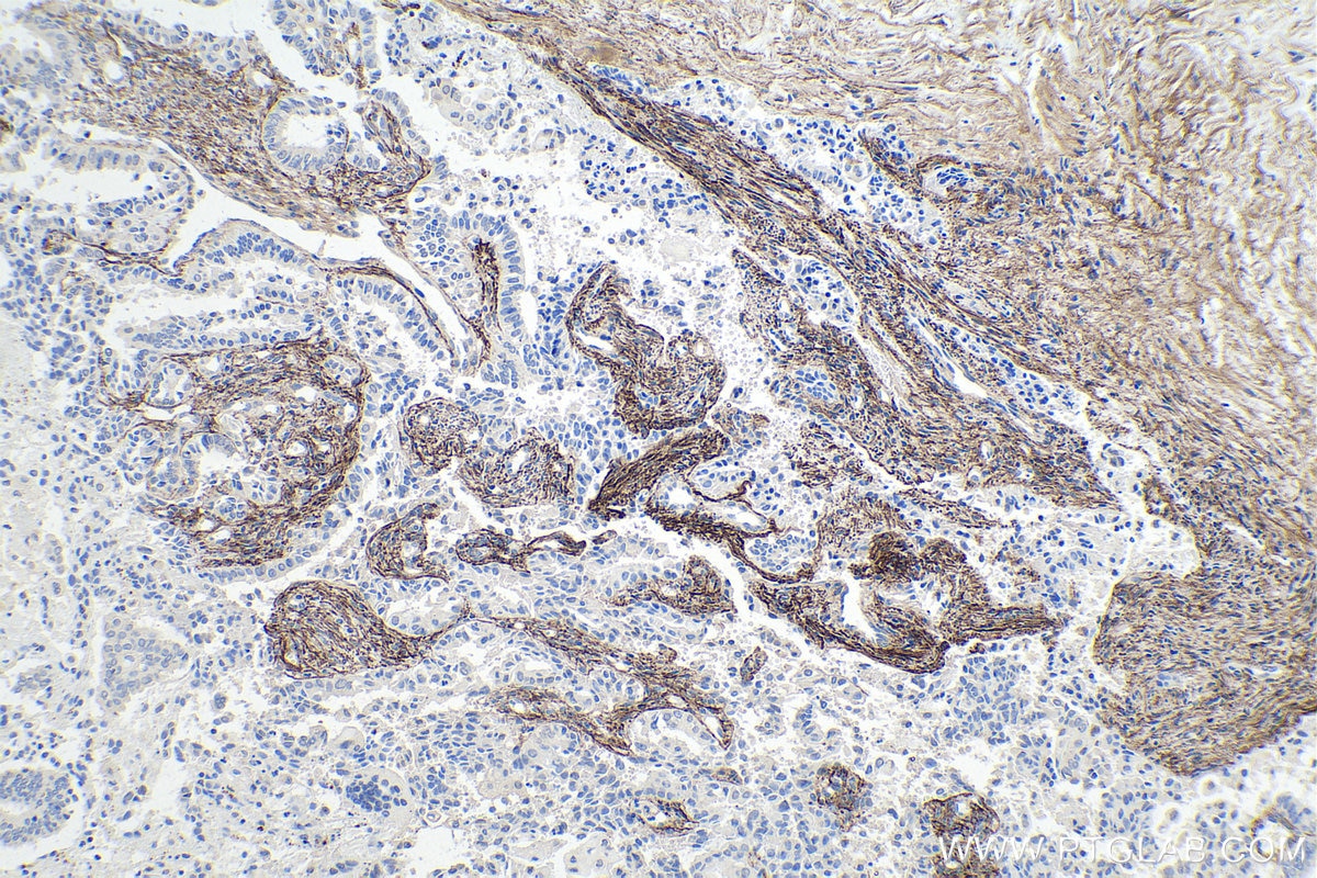 Immunohistochemical analysis of paraffin-embedded human ovary tumor tissue slide using KHC0202 (EMILIN1 IHC Kit).