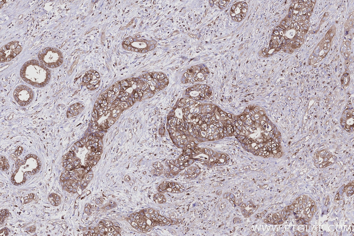Immunohistochemical analysis of paraffin-embedded human pancreas cancer tissue slide using KHC2931 (EML4 IHC Kit). Immunohistochemical analysis of paraffin-embedded human pancreas cancer tissue slide using KHC2931 (EML4 IHC Kit).