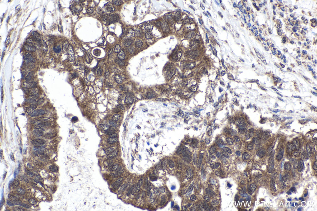 Immunohistochemical analysis of paraffin-embedded human urothelial carcinoma tissue slide using KHC1674 (EMX1 IHC Kit).