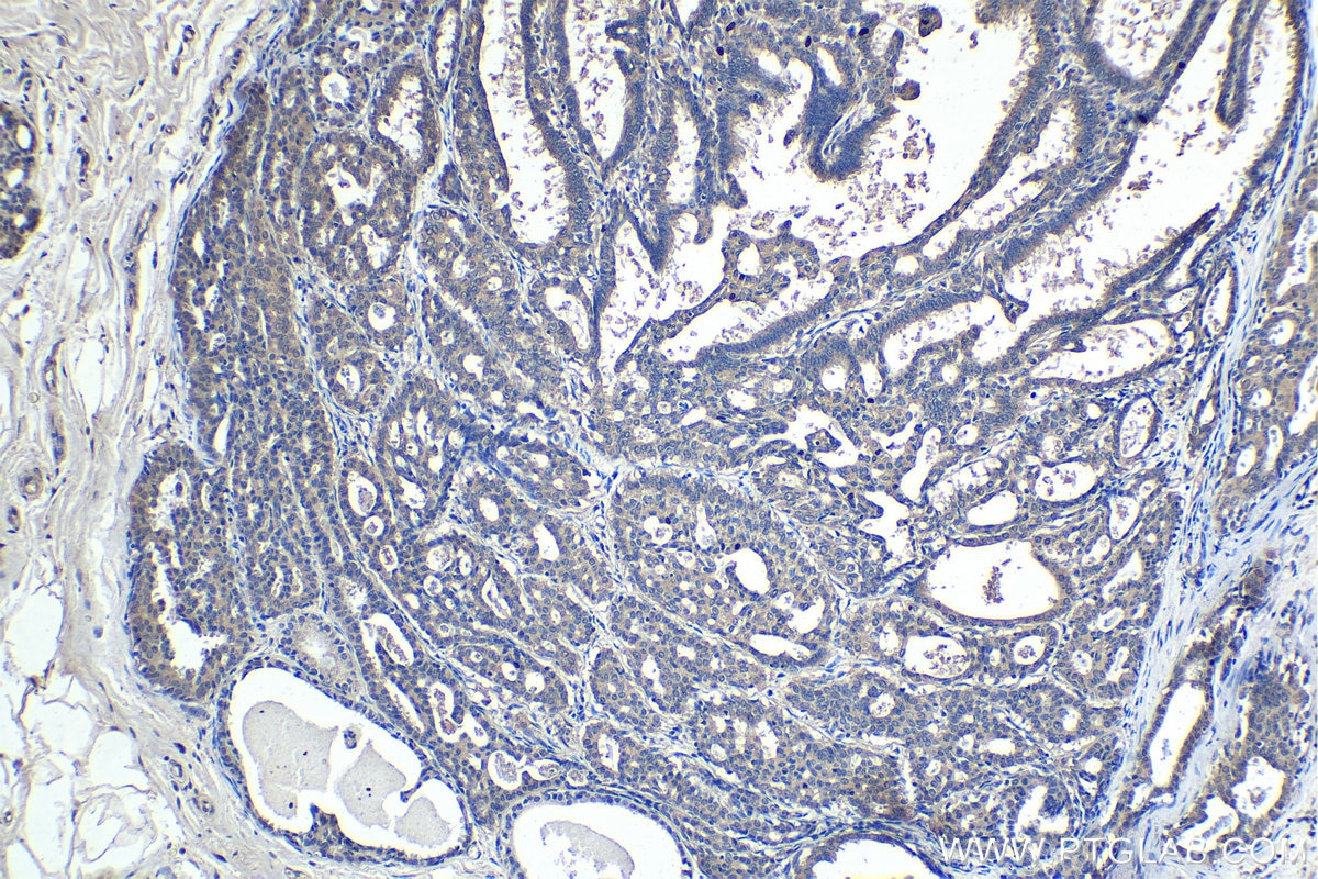 Immunohistochemical analysis of paraffin-embedded human breast cancer tissue slide using KHC1426 (ENC1 IHC Kit).