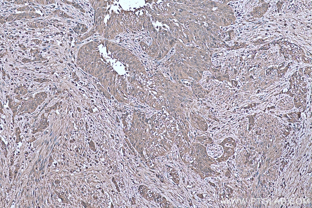 Immunohistochemical analysis of paraffin-embedded human urothelial carcinoma tissue slide using KHC0656 (ENO1 IHC Kit).
