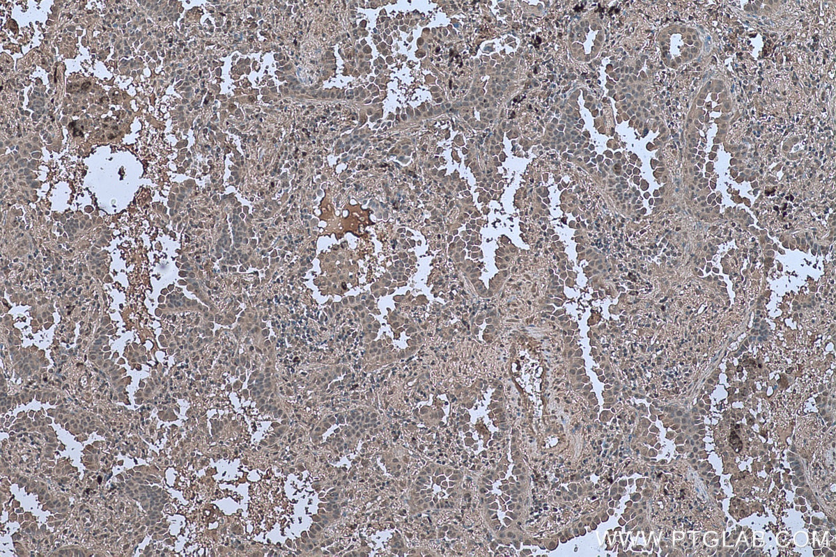 Immunohistochemical analysis of paraffin-embedded human lung cancer tissue slide using KHC0656 (ENO1 IHC Kit).