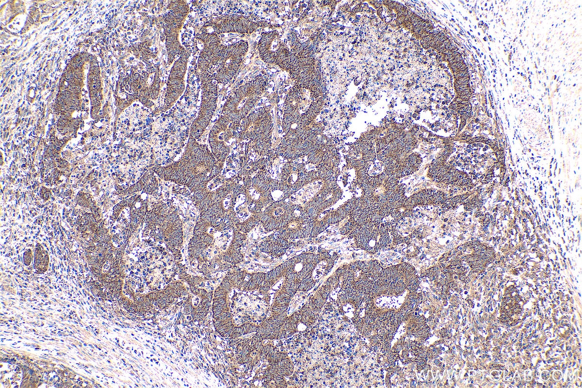 Immunohistochemical analysis of paraffin-embedded human colon cancer tissue slide using KHC0587 (ENO3 IHC Kit).