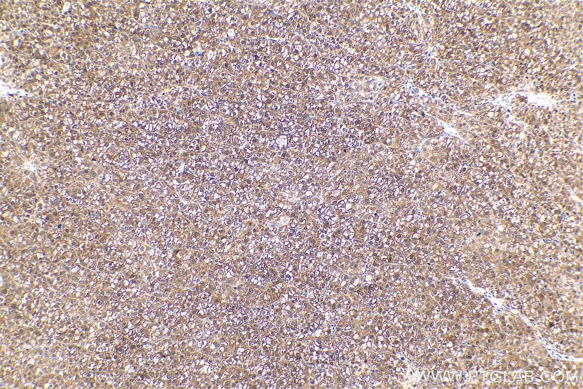 Immunohistochemical analysis of paraffin-embedded human liver cancer tissue slide using KHC0587 (ENO3 IHC Kit).