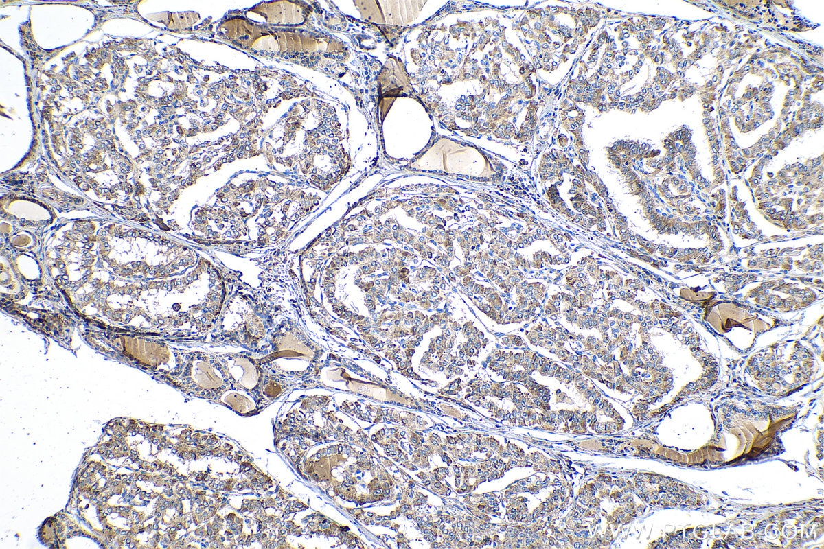 Immunohistochemical analysis of paraffin-embedded human thyroid cancer tissue slide using KHC0587 (ENO3 IHC Kit).