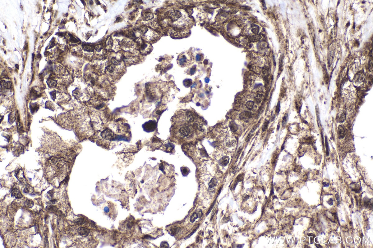 Immunohistochemical analysis of paraffin-embedded human pancreas cancer tissue slide using KHC1688 (EP300 IHC Kit).