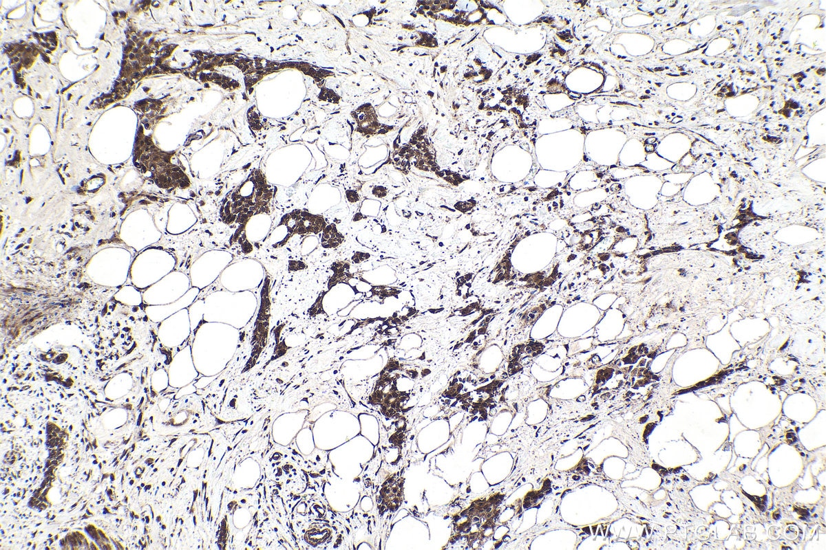 Immunohistochemical analysis of paraffin-embedded human urothelial carcinoma tissue slide using KHC1688 (EP300 IHC Kit).