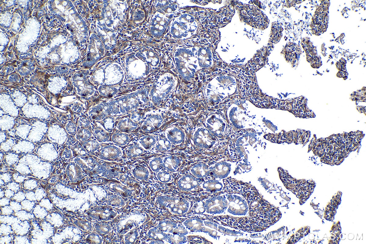 Immunohistochemical analysis of paraffin-embedded human stomach cancer tissue slide using KHC1270 (EPB41L2 IHC Kit).