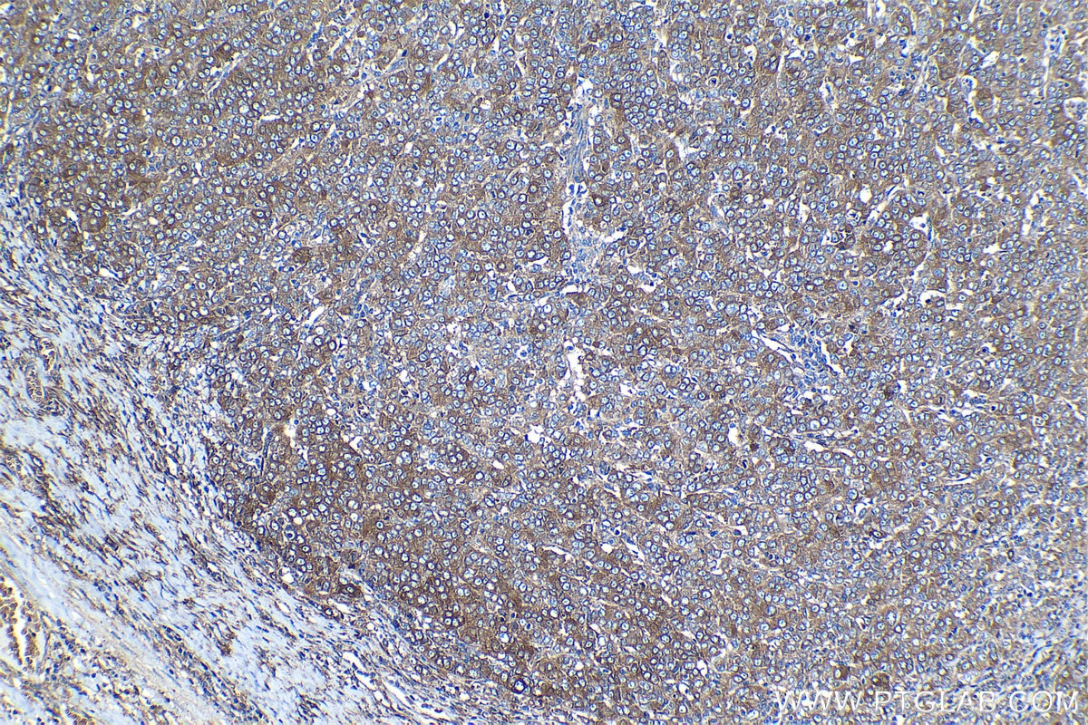 Immunohistochemical analysis of paraffin-embedded human ovary tumor tissue slide using KHC1270 (EPB41L2 IHC Kit).
