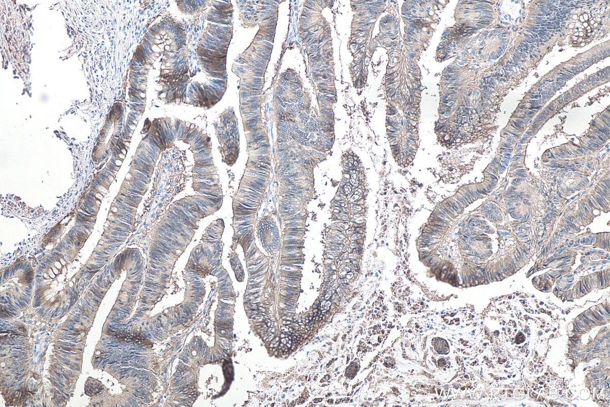 Immunohistochemical analysis of paraffin-embedded human colon cancer tissue slide using KHC0085 (EPCAM IHC Kit).