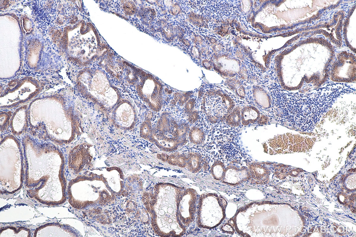 Immunohistochemical analysis of paraffin-embedded human thyroid cancer tissue slide using KHC0085 (EPCAM IHC Kit).