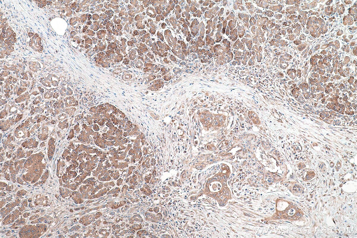 Immunohistochemical analysis of paraffin-embedded human pancreas cancer tissue slide using KHC0869 (EPRS IHC Kit).