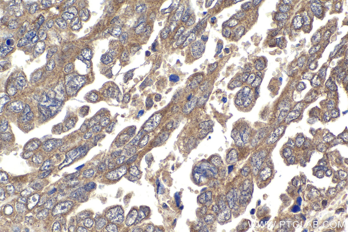 Immunohistochemical analysis of paraffin-embedded human ovary tumor tissue slide using KHC1883 (ERBIN IHC Kit).