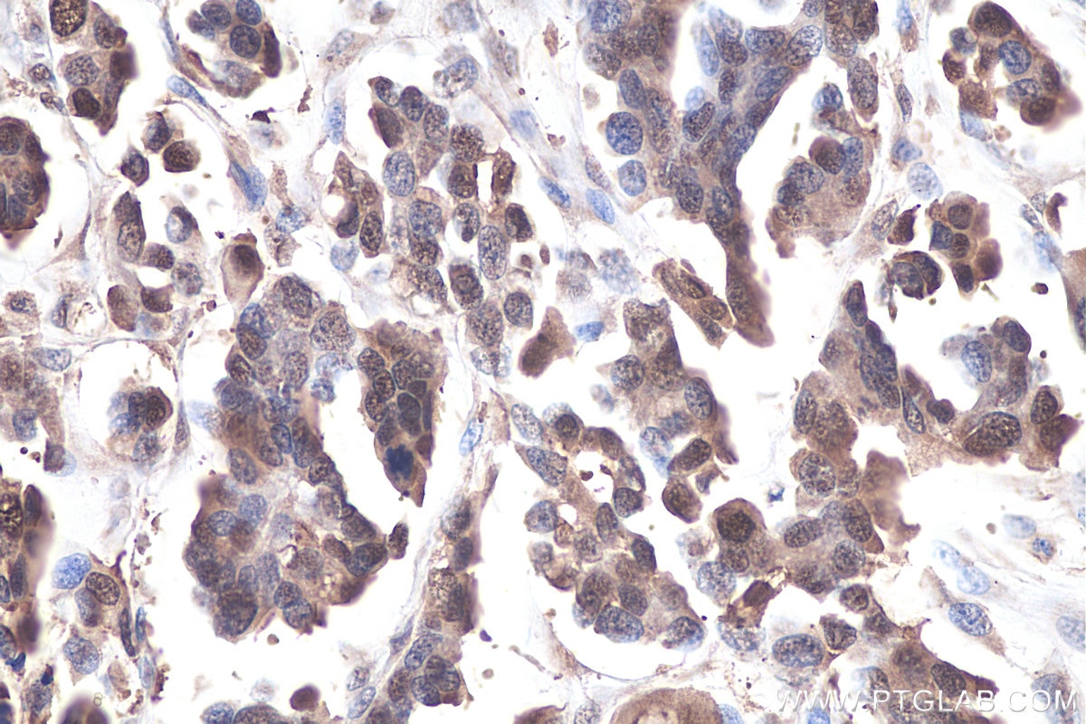 Immunohistochemical analysis of paraffin-embedded human colon cancer tissue slide using KHC0917 (ERK1/2 IHC Kit).