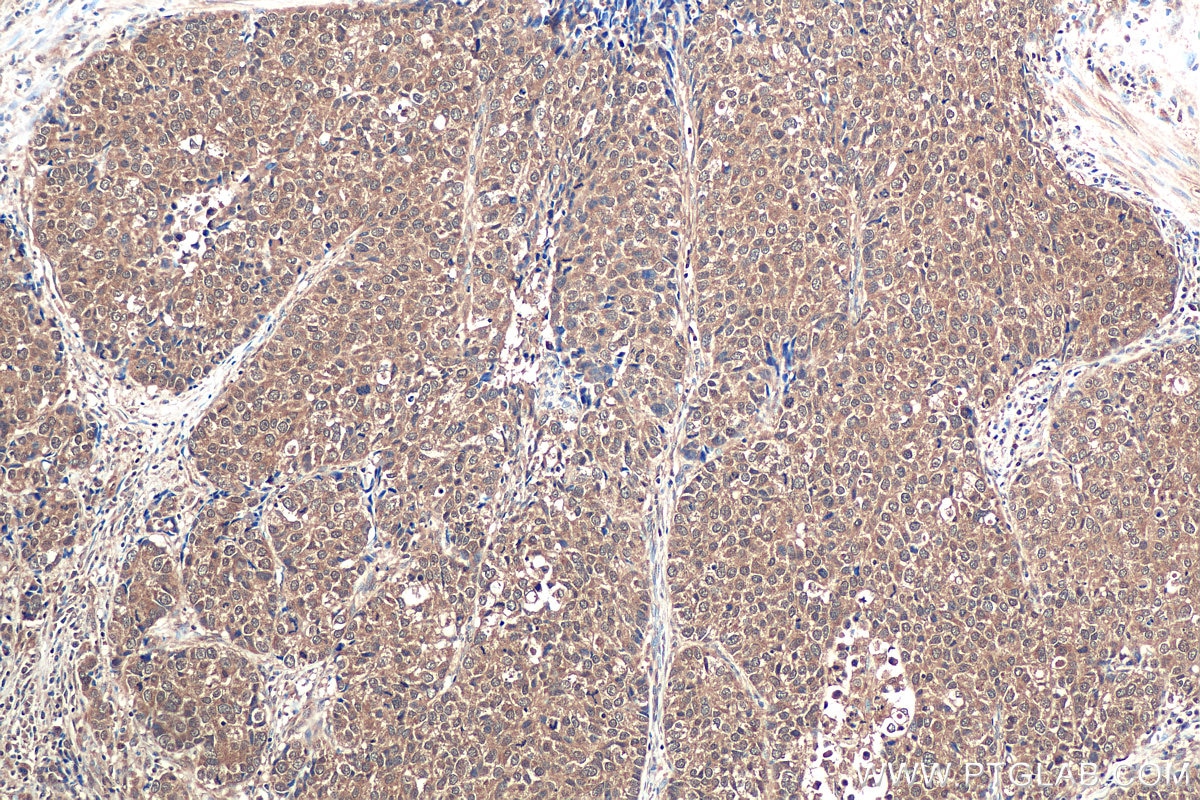 Immunohistochemical analysis of paraffin-embedded human stomach cancer tissue slide using KHC0917 (ERK1/2 IHC Kit).