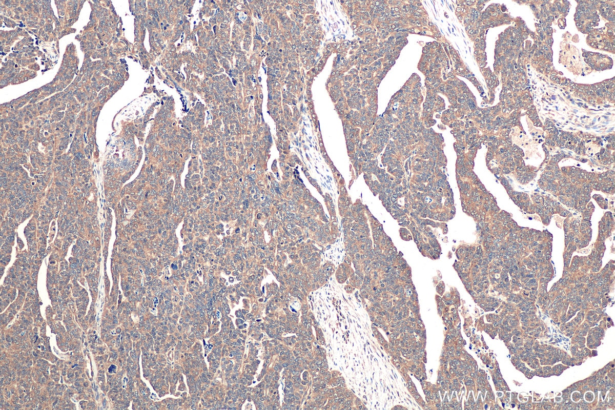 Immunohistochemical analysis of paraffin-embedded human ovary tumor tissue slide using KHC0917 (ERK1/2 IHC Kit).