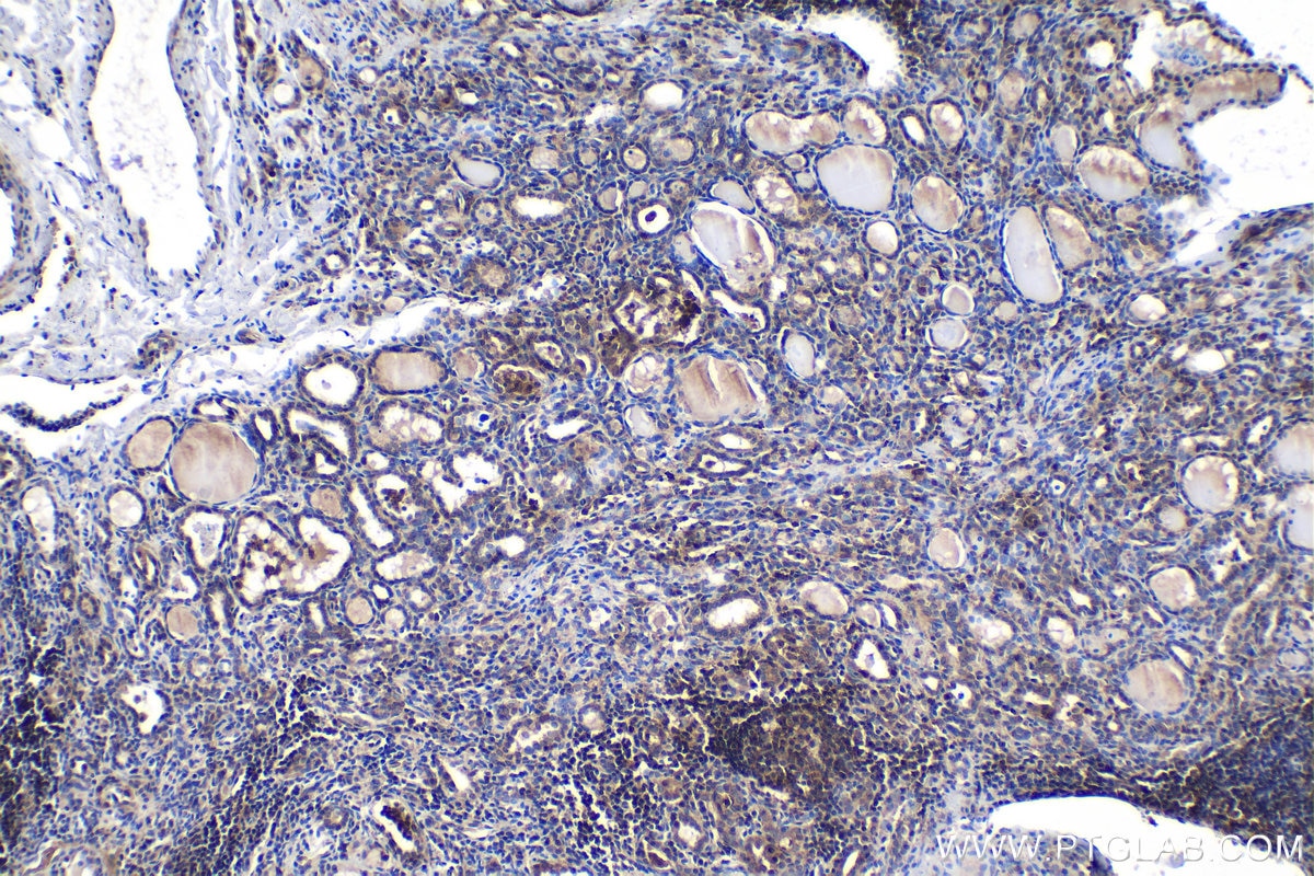 Immunohistochemical analysis of paraffin-embedded human thyroid cancer tissue slide using KHC1525 (ESRRA IHC Kit).