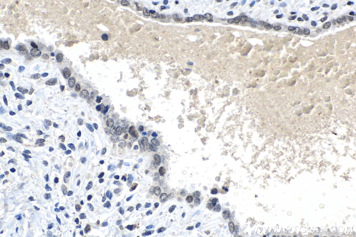 Immunohistochemical analysis of paraffin-embedded human cervical cancer tissue slide using KHC1499 (ESRRB IHC Kit).