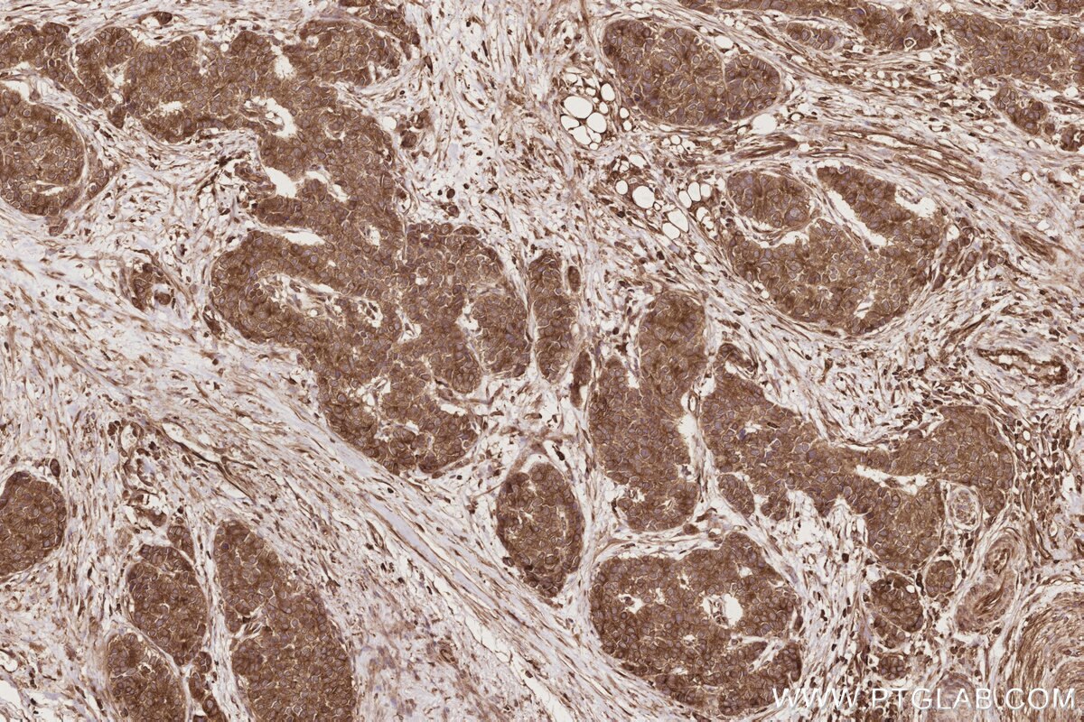 Immunohistochemical analysis of paraffin-embedded human stomach cancer tissue slide using KHC2861 (ESYT1 IHC Kit).