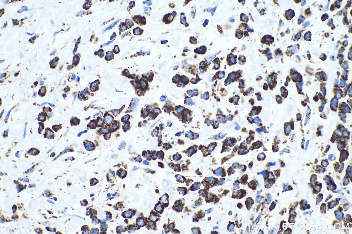Immunohistochemical analysis of paraffin-embedded human stomach cancer tissue slide using KHC0544 (ETFA IHC Kit).