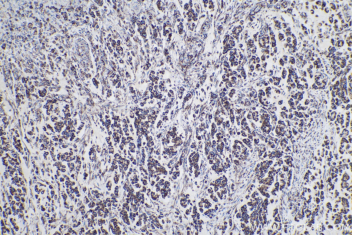 Immunohistochemical analysis of paraffin-embedded human colon cancer tissue slide using KHC0544 (ETFA IHC Kit).