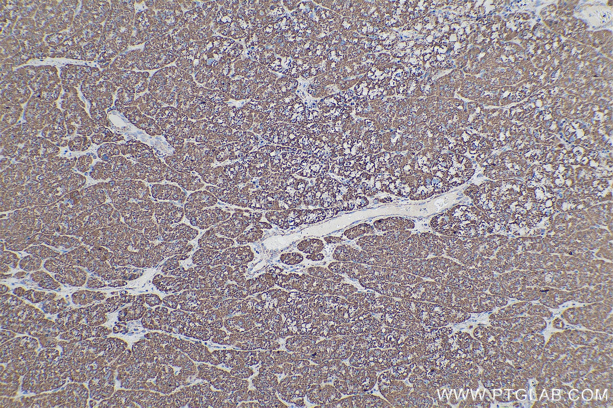 Immunohistochemical analysis of paraffin-embedded human liver cancer tissue slide using KHC0544 (ETFA IHC Kit).