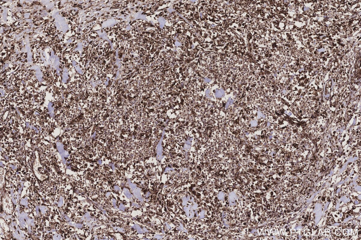 Immunohistochemical analysis of paraffin-embedded human colon cancer tissue slide using KHC3207 (ETFB IHC Kit).