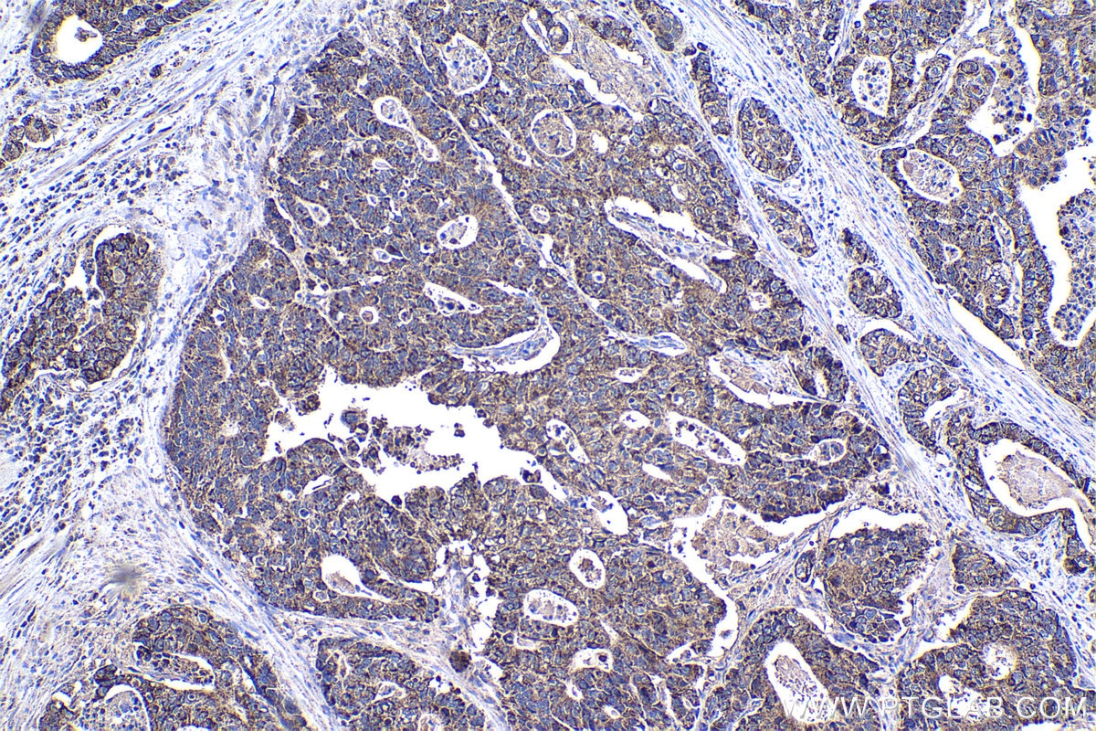 Immunohistochemical analysis of paraffin-embedded human stomach cancer tissue slide using KHC1496 (ETHE1 IHC Kit).