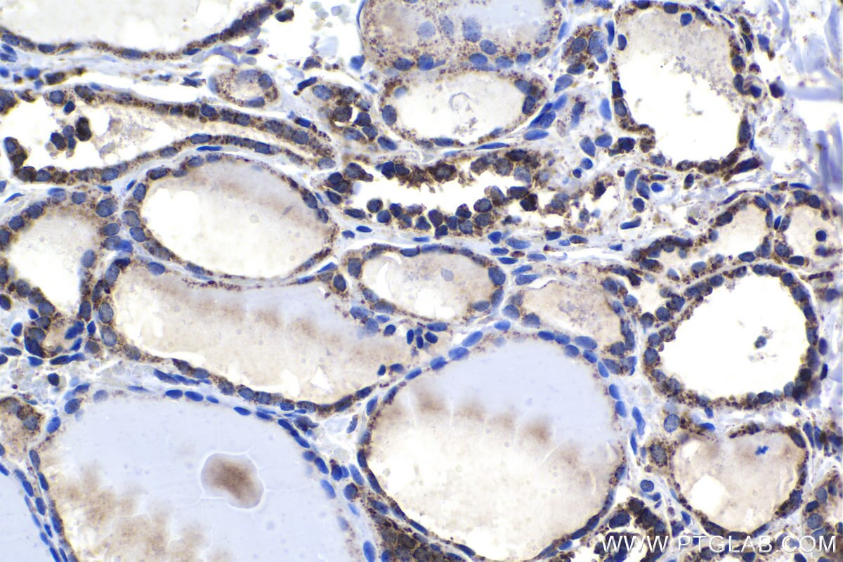 Immunohistochemical analysis of paraffin-embedded human thyroid cancer tissue slide using KHC1496 (ETHE1 IHC Kit).