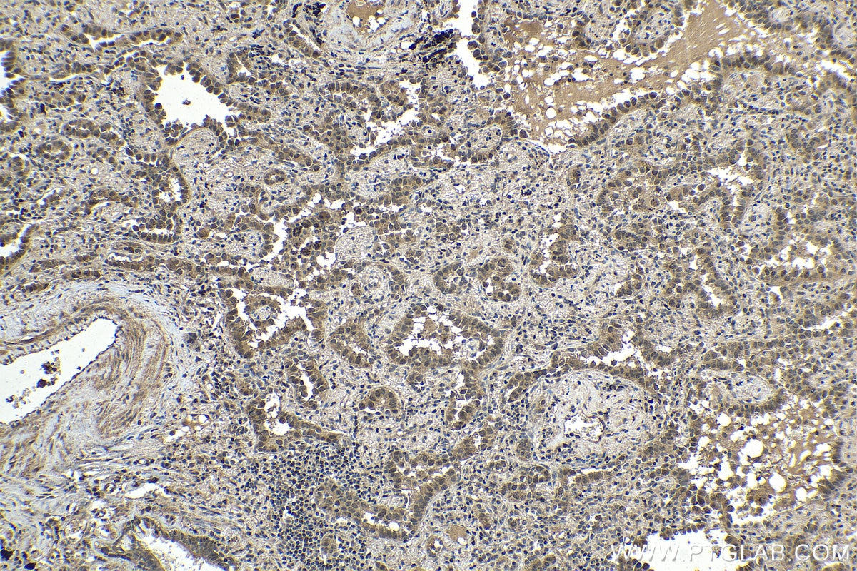 Immunohistochemical analysis of paraffin-embedded human lung cancer tissue slide using KHC1533 (ETS1 IHC Kit).