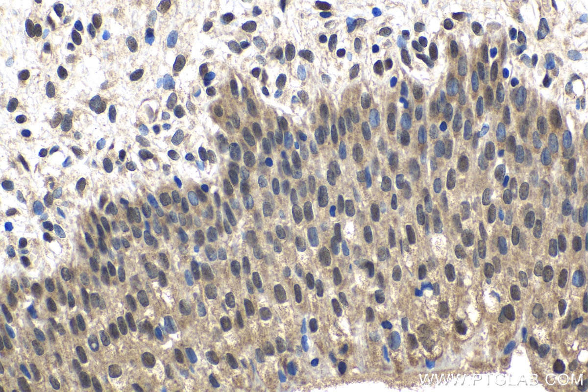 Immunohistochemical analysis of paraffin-embedded human urothelial carcinoma tissue slide using KHC1534 (ETS2 IHC Kit).