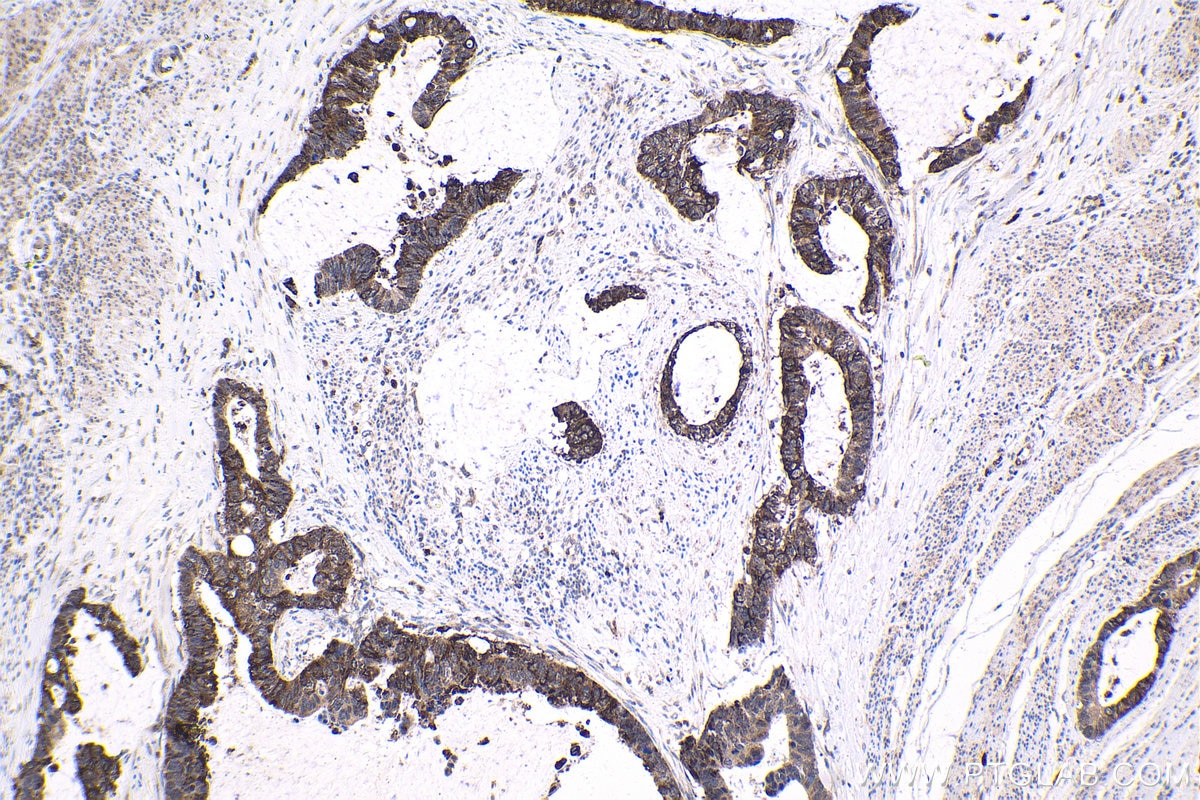 Immunohistochemical analysis of paraffin-embedded human urothelial carcinoma tissue slide using KHC1672 (EVI1 IHC Kit).