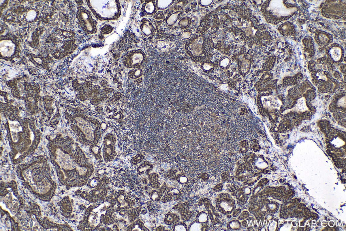 Immunohistochemical analysis of paraffin-embedded human thyroid cancer tissue slide using KHC1667 (EWSR1/EWS IHC Kit).