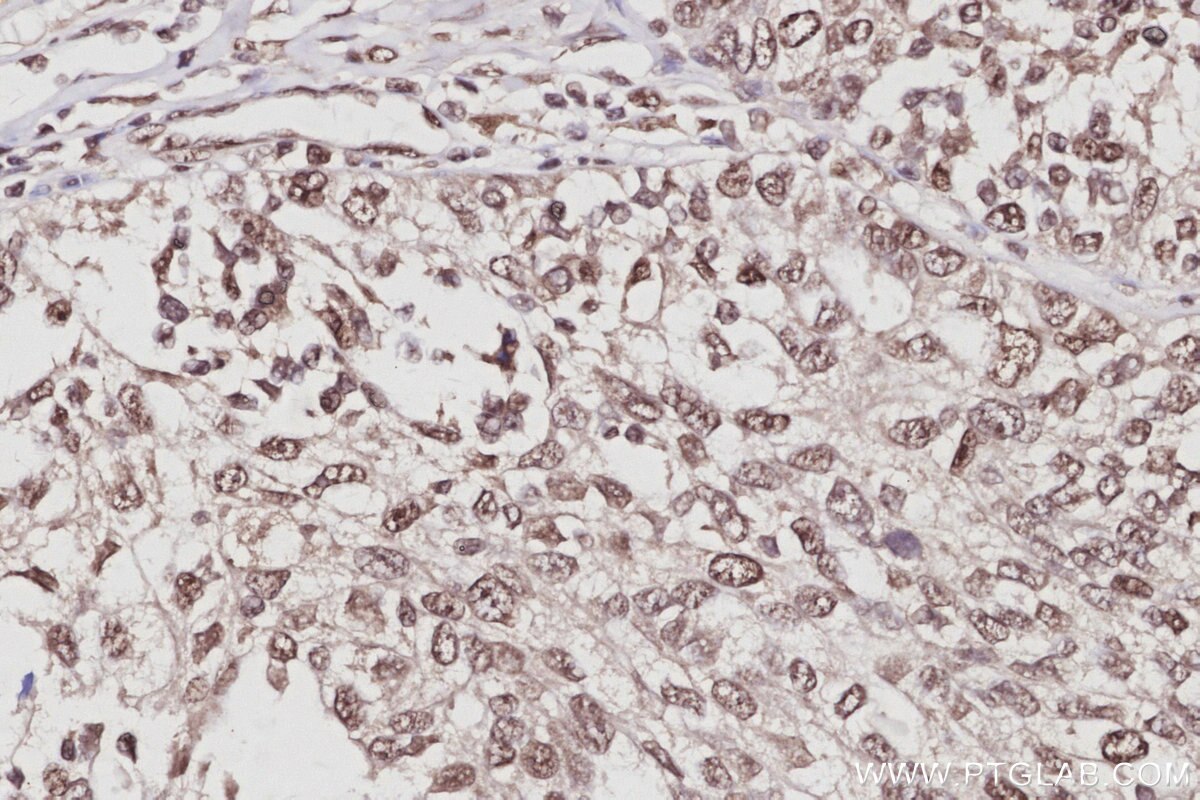 Immunohistochemical analysis of paraffin-embedded human ovary cancer tissue slide using KHC3061 (EXOSC1 IHC Kit).