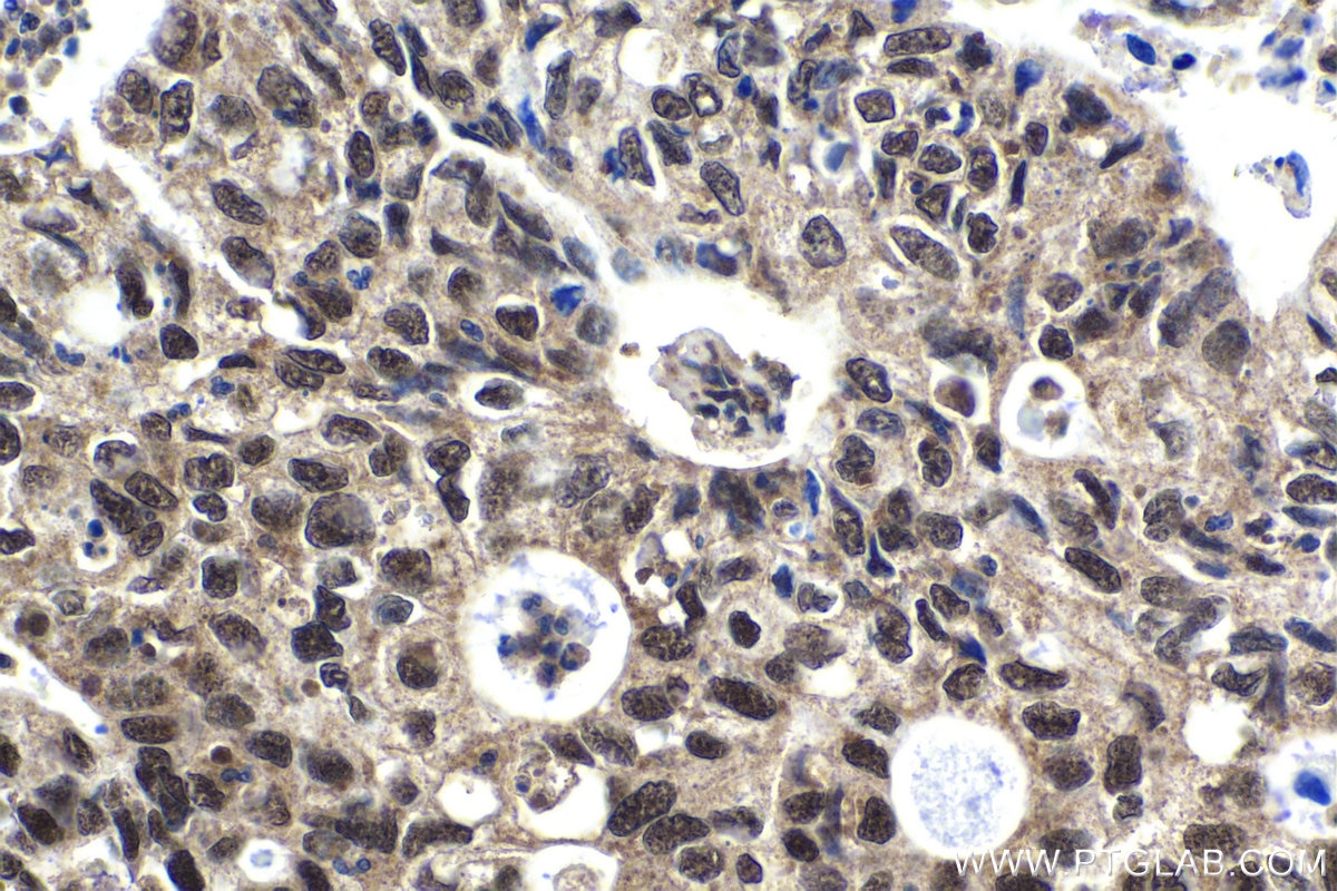 Immunohistochemical analysis of paraffin-embedded human stomach cancer tissue slide using KHC1665 (EXOSC10 IHC Kit).