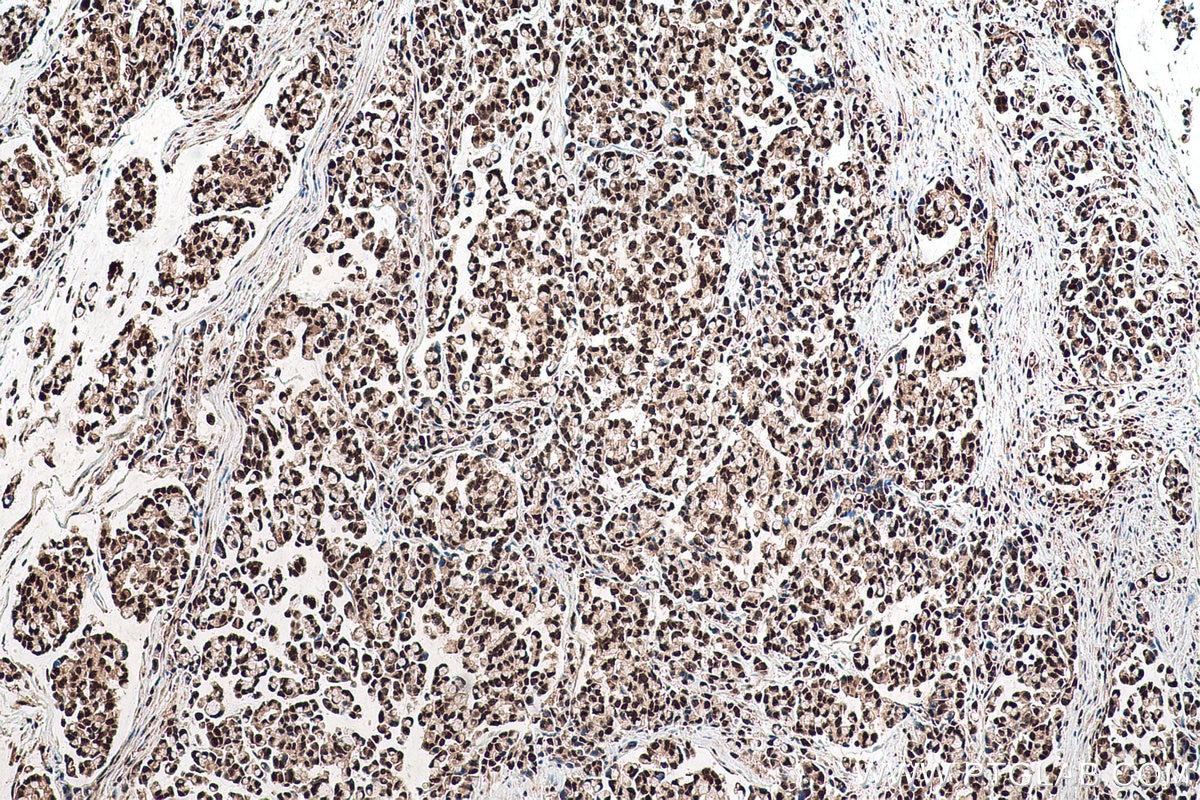 Immunohistochemical analysis of paraffin-embedded human colon cancer tissue slide using KHC0955 (EXOSC7 IHC Kit).