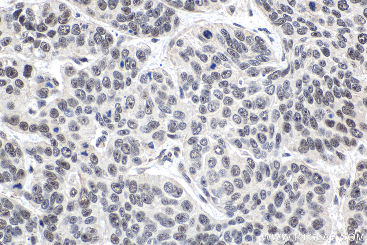 Immunohistochemical analysis of paraffin-embedded human oesophagus cancer tissue slide using KHC1678 (EXOSC9 IHC Kit).