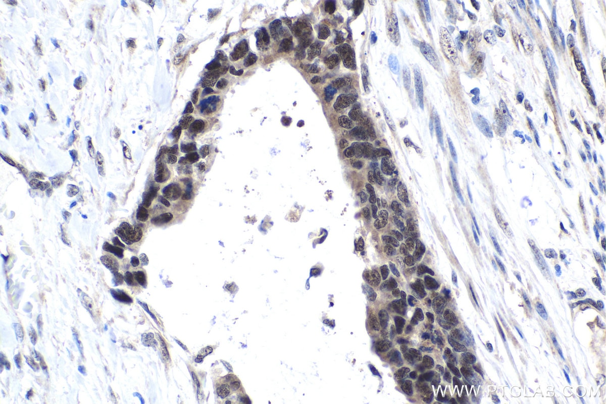 Immunohistochemical analysis of paraffin-embedded human urothelial carcinoma tissue slide using KHC1678 (EXOSC9 IHC Kit).