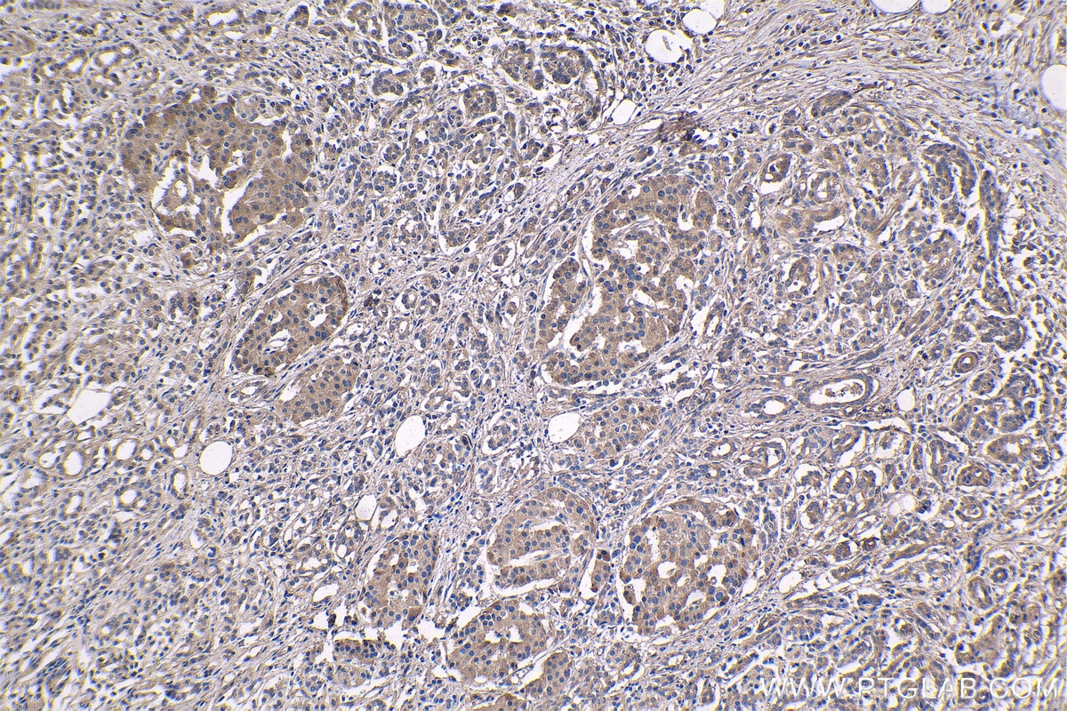 Immunohistochemical analysis of paraffin-embedded human pancreas cancer tissue slide using KHC1417 (EYA2 IHC Kit).