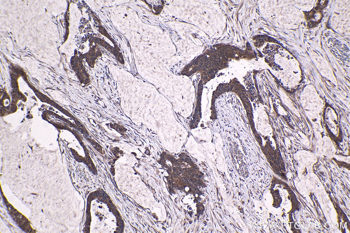 Immunohistochemical analysis of paraffin-embedded human urothelial carcinoma tissue slide using KHC1417 (EYA2 IHC Kit).