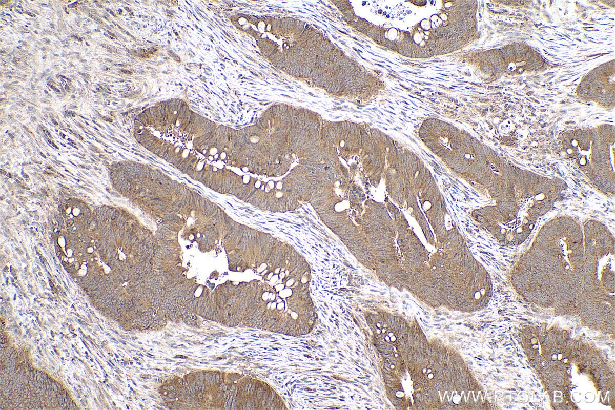 Immunohistochemical analysis of paraffin-embedded human colon cancer tissue slide using KHC0767 (EYA4 IHC Kit).