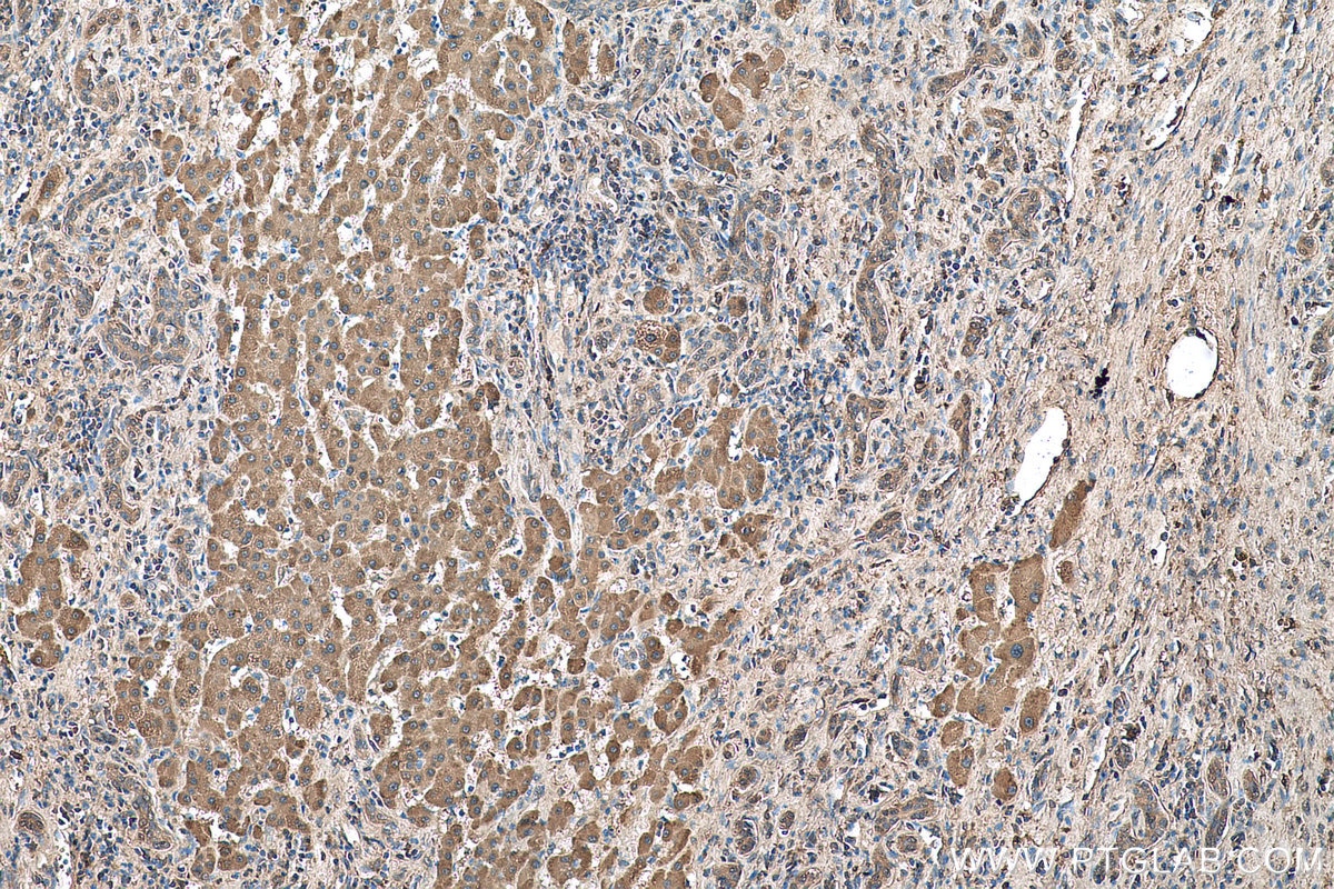 Immunohistochemical analysis of paraffin-embedded human liver cancer tissue slide using KHC0739 (F13A1 IHC Kit).