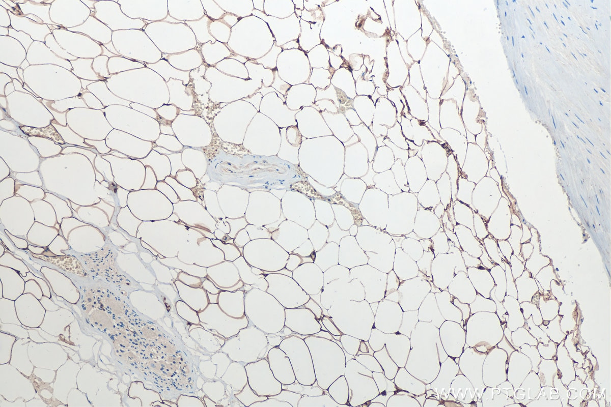 Immunohistochemical analysis of paraffin-embedded human prostate cancer tissue slide using KHC0237 (FABP4 IHC Kit).