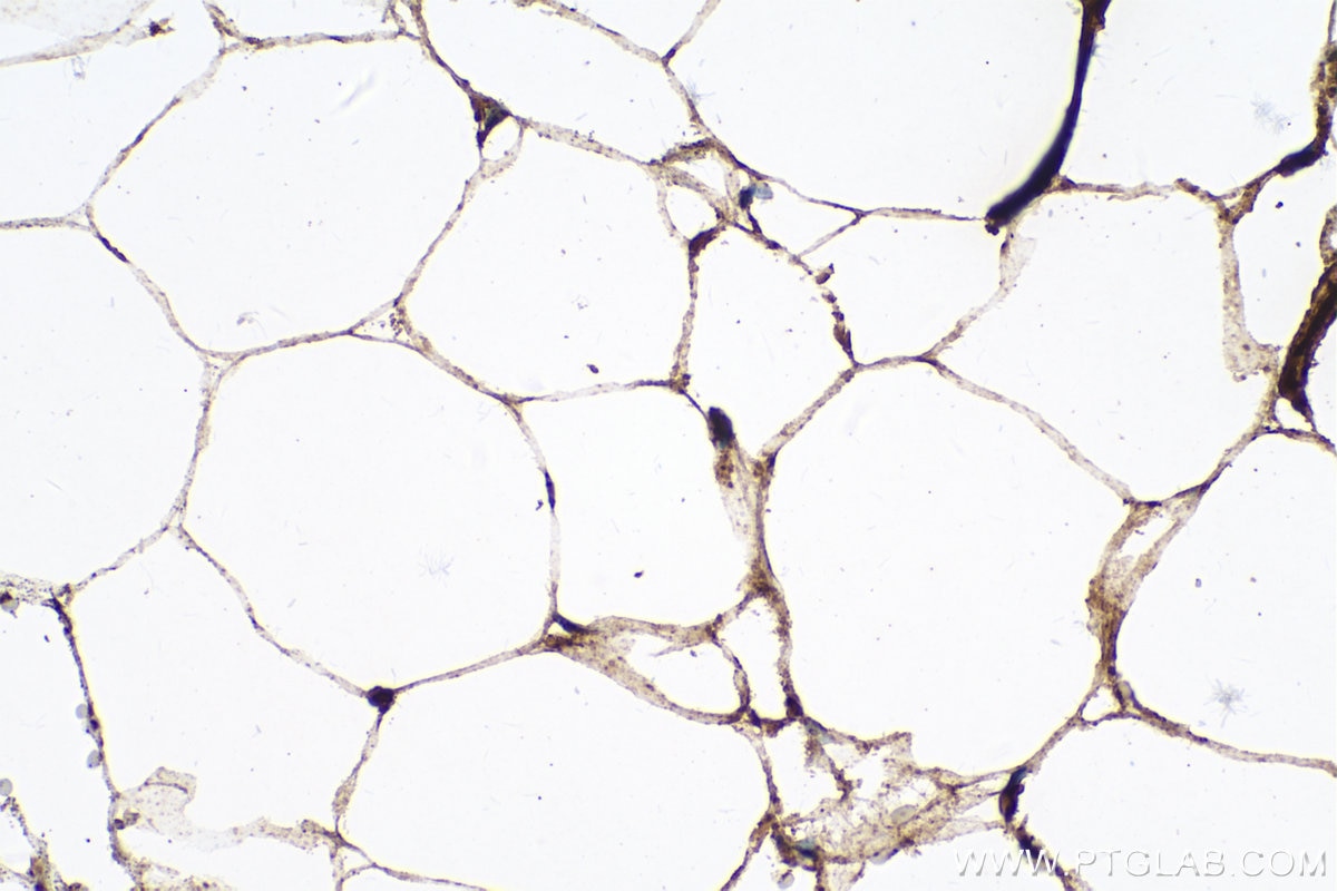 Immunohistochemical analysis of paraffin-embedded human prostate cancer tissue slide using KHC0238 (FABP5 IHC Kit).