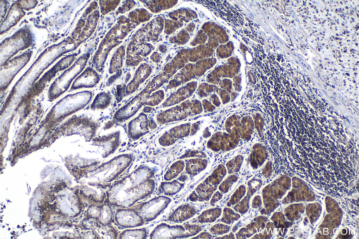 Immunohistochemical analysis of paraffin-embedded human stomach cancer tissue slide using KHC1251 (FADD IHC Kit).